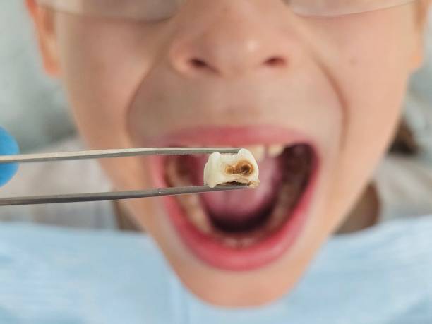 Best Emergency Dental Care for Broken or Chipped Teeth in Valhalla, NY