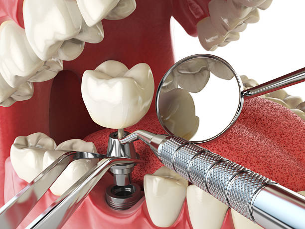 Best Emergency Tooth Extraction in Valhalla, NY